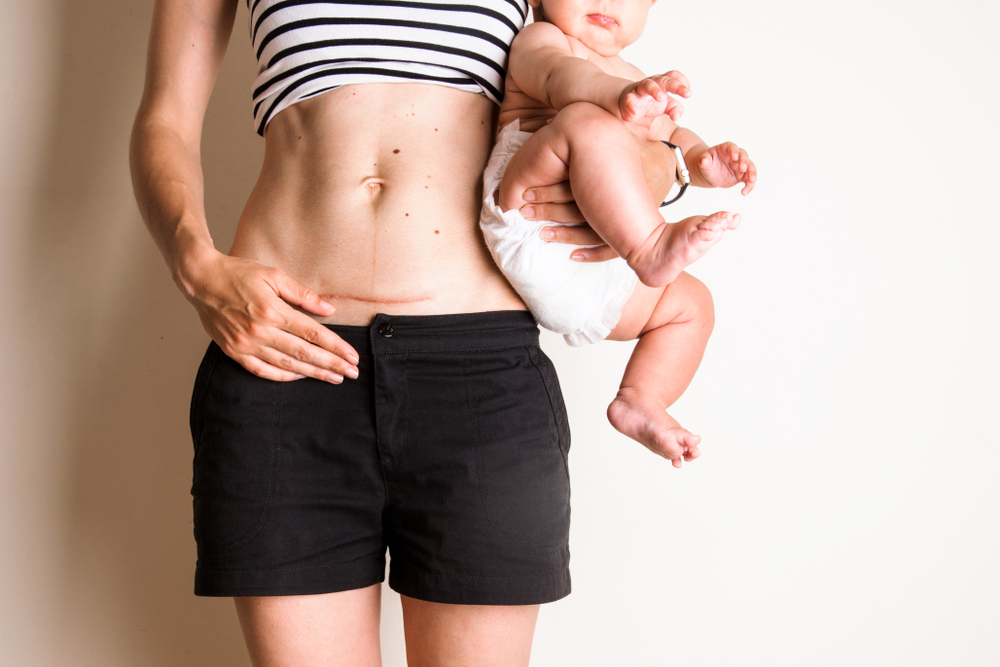 mother with c-section scar holding her baby.